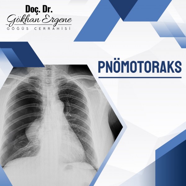 Pnömotoraks 1