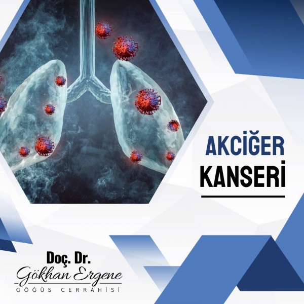 Akciğer Kanseri