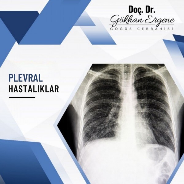 Plevral Hastalıklar 1
