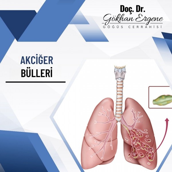 Akciğer Bülleri 1