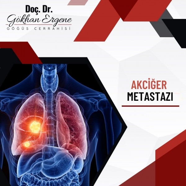 Akciğer Metastazı 1