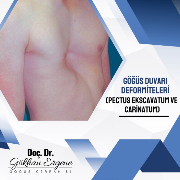 Göğüs Duvarı Şekil Bozuklukları 1